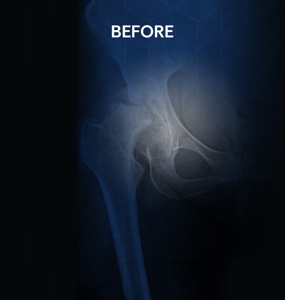 Before X-ray of a 58-year-old female patient's hip showing severe avascular necrosis of the right femoral head prior to minimally invasive anterior total hip replacement surgery by Dr. Jeffrey A. Geller MD.