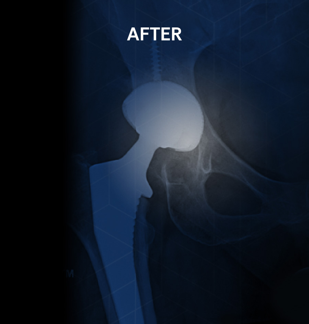 After X-ray of the same hip following minimally invasive anterior total hip replacement surgery by Dr. Jeffrey A. Geller MD, showing a successfully implanted hip prosthesis, allowing the patient to walk unassisted post-operation.