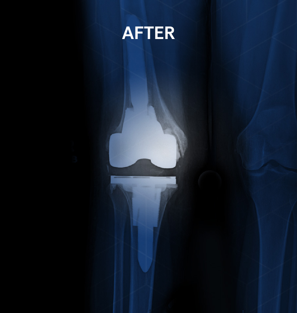 After X-ray of the same knee following extensive revision knee replacement surgery by Dr. Jeffrey A. Geller MD, showing a new prosthetic implant restoring improved function, stability, and the ability to walk and climb stairs.