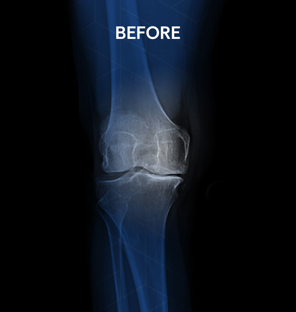  Before X-ray of a 58-year-old female patient's knee requiring minimally invasive partial knee replacement surgery performed by Dr. Jeffrey A. Geller MD.