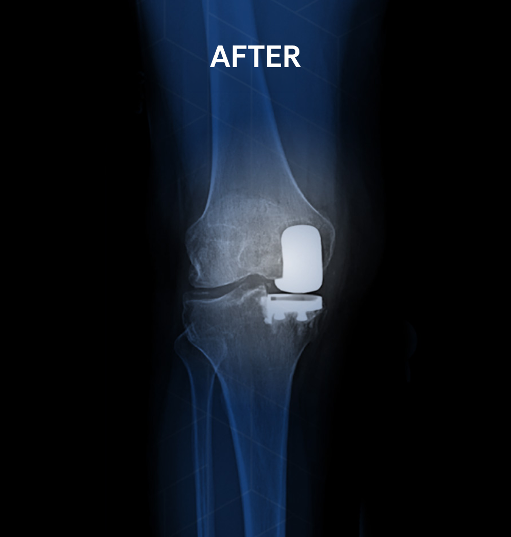 After X-ray of the same knee following minimally invasive partial knee replacement surgery by Dr. Jeffrey A. Geller MD, showing a successfully implanted partial knee prosthesis allowing the patient to return to spin class, bicycling, and tennis.