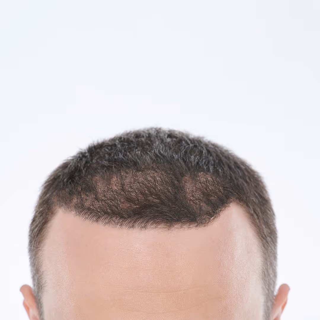 Nach der Haartransplantation