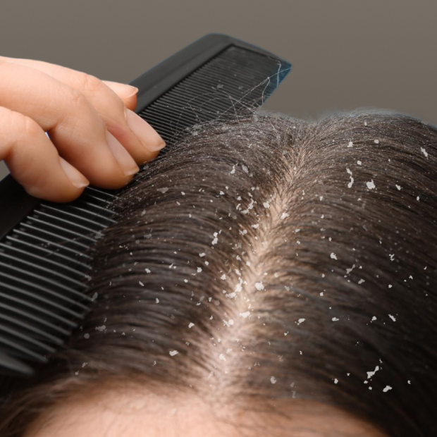 Close-up of a person's scalp with visible dandruff flakes and a black comb being used to part the hair.