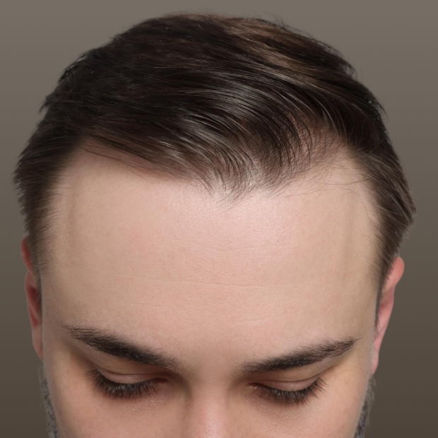 Close-up of a man's forehead and scalp showing thinning hair and a receding hairline.