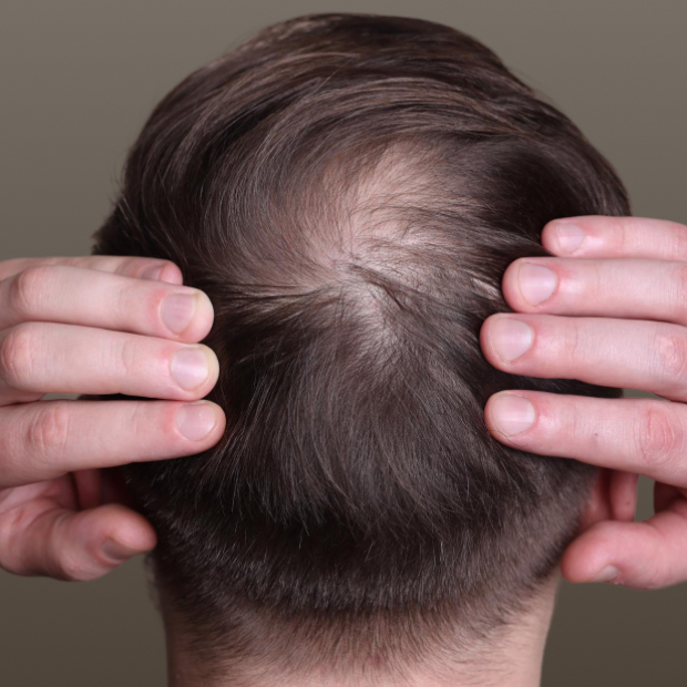 Rear view of a man's head showing thinning hair and a bald spot with hands parting the hair.