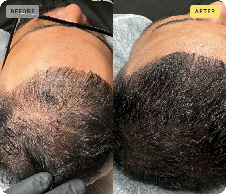 Side-by-side comparison of a man's scalp before and after a hair restoration treatment, showing increased hair density and darker hair color in the after image.