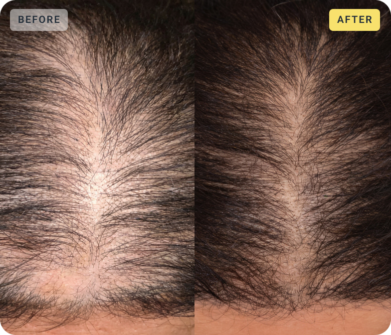 Close-up side-by-side comparison of a scalp before and after hair treatment showing increased hair density and coverage on the right.