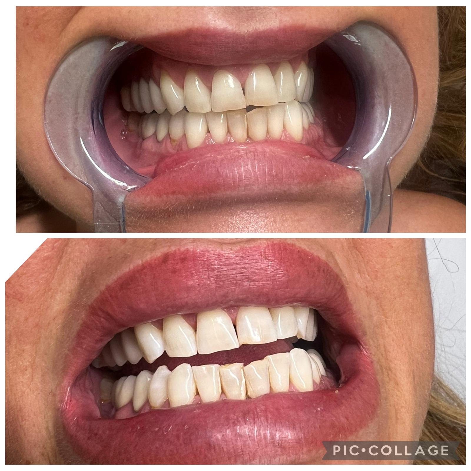 Vorher-Nachher Ergebnis einer kosmetischen Zahnaufhellung bei MyMedBeauty in Traisen