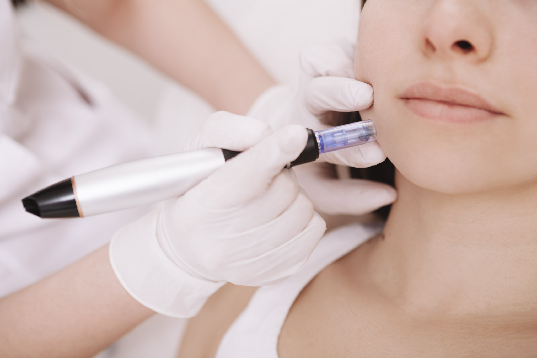 Microneedling in Traisen mit individuell abgestimmten Wirkstoffen zur Förderung der Hautregeneration.