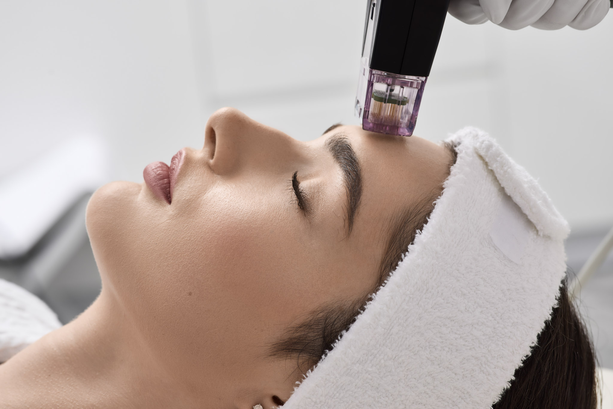 Radiofrequenz Hautstraffung bei MyMedBeauty in Traisen zur Förderung der Kollagenbildung und Straffung der Haut.