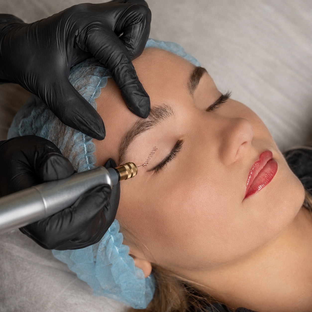 Plasma Pen Behandlung zur Hautstraffung und Hautverjüngung bei MyMedBeauty in Traisen.