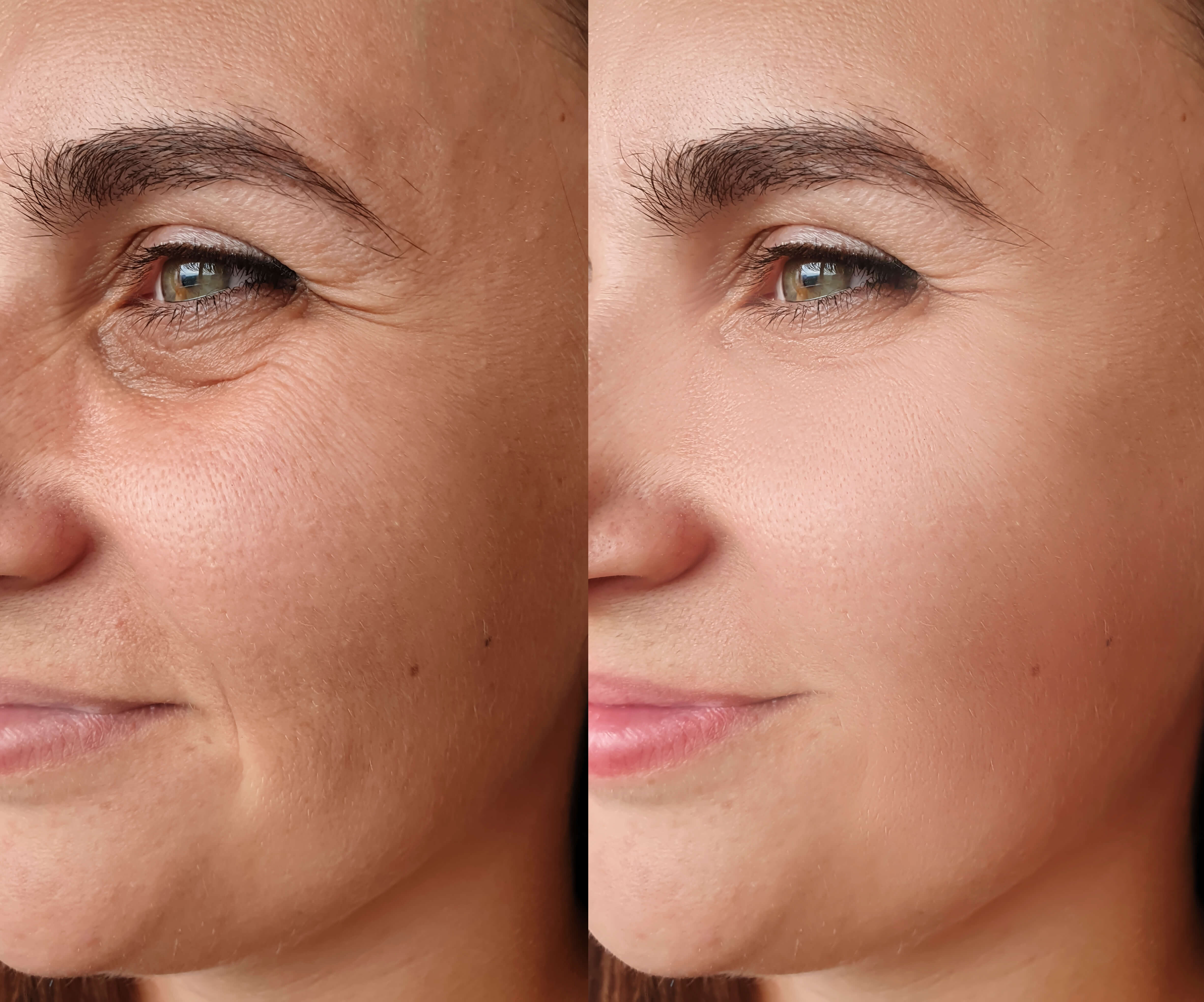 EMS Facelift Vorher Nachher Vergleich – glattere Augenpartie und Wange nach der Behandlung