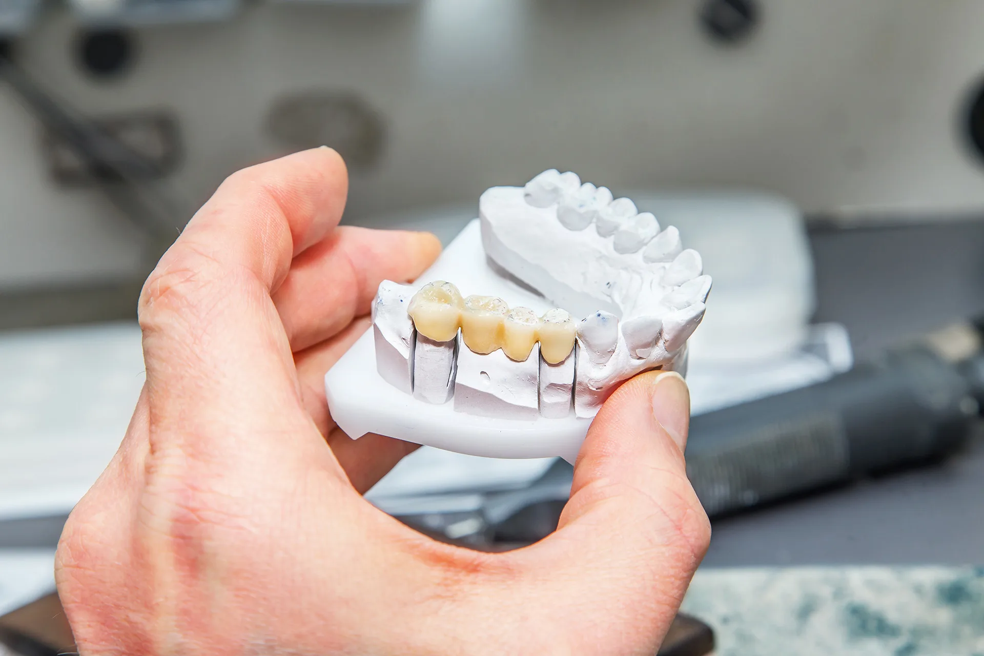 Dental Bridges in Sanford FL