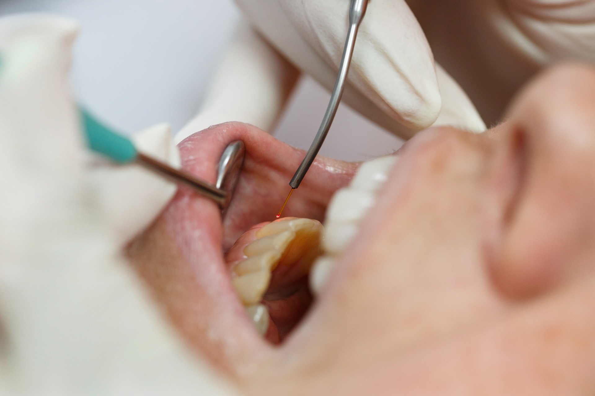 Apicoectomies in Concord