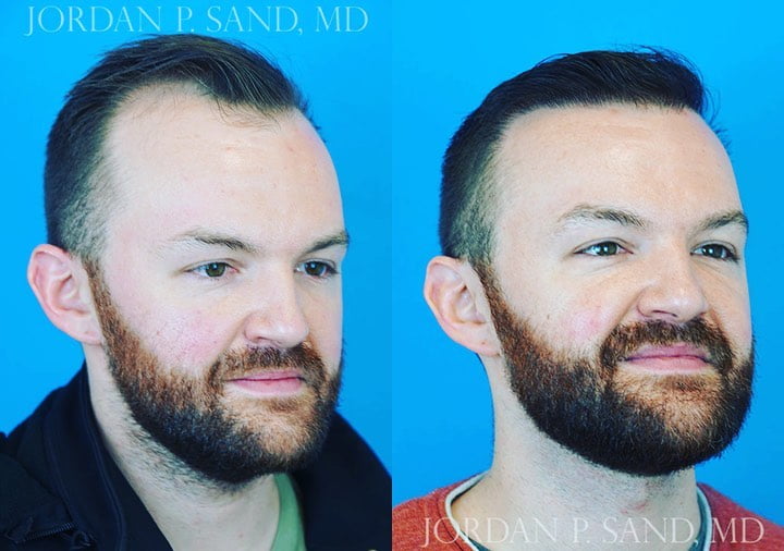 Before and after hair transplant for temple hairline recession by Dr. Sand