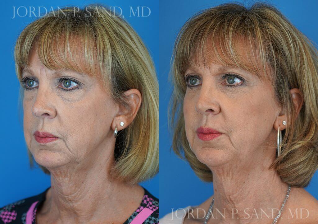 Before and after seamless lower eye and cheek lift — dark circles corrected
