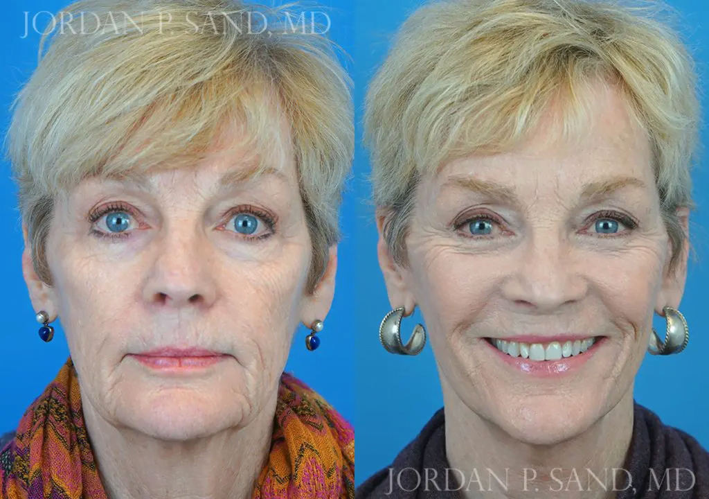 Before and after Sand Signature Lift — improved jawline, cheeks, and under-eye area