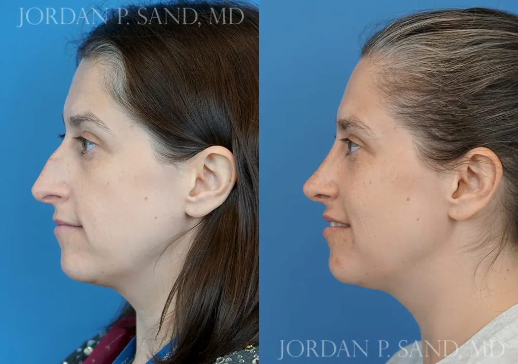 Before and after rhinoplasty — nasal bump removed and airway opened