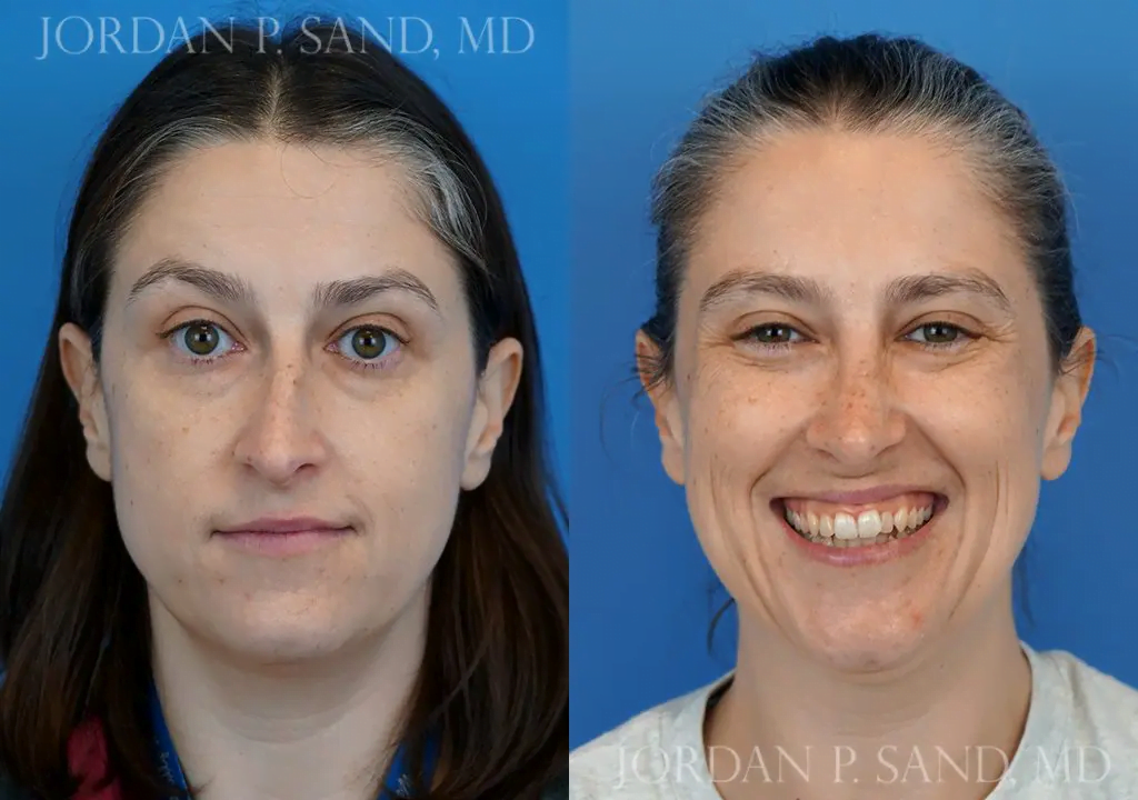 Before and after rhinoplasty — nasal bump removed and airway opened