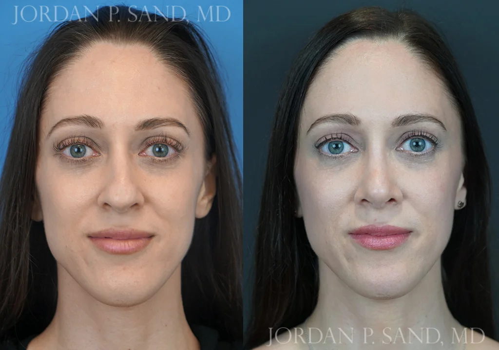 Before and after rhinoplasty — large, crooked nose balanced and refined