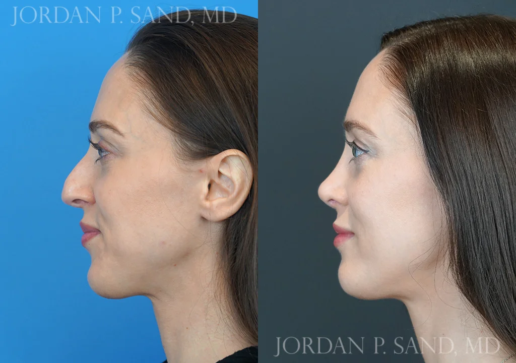 Before and after rhinoplasty — large, crooked nose balanced and refined