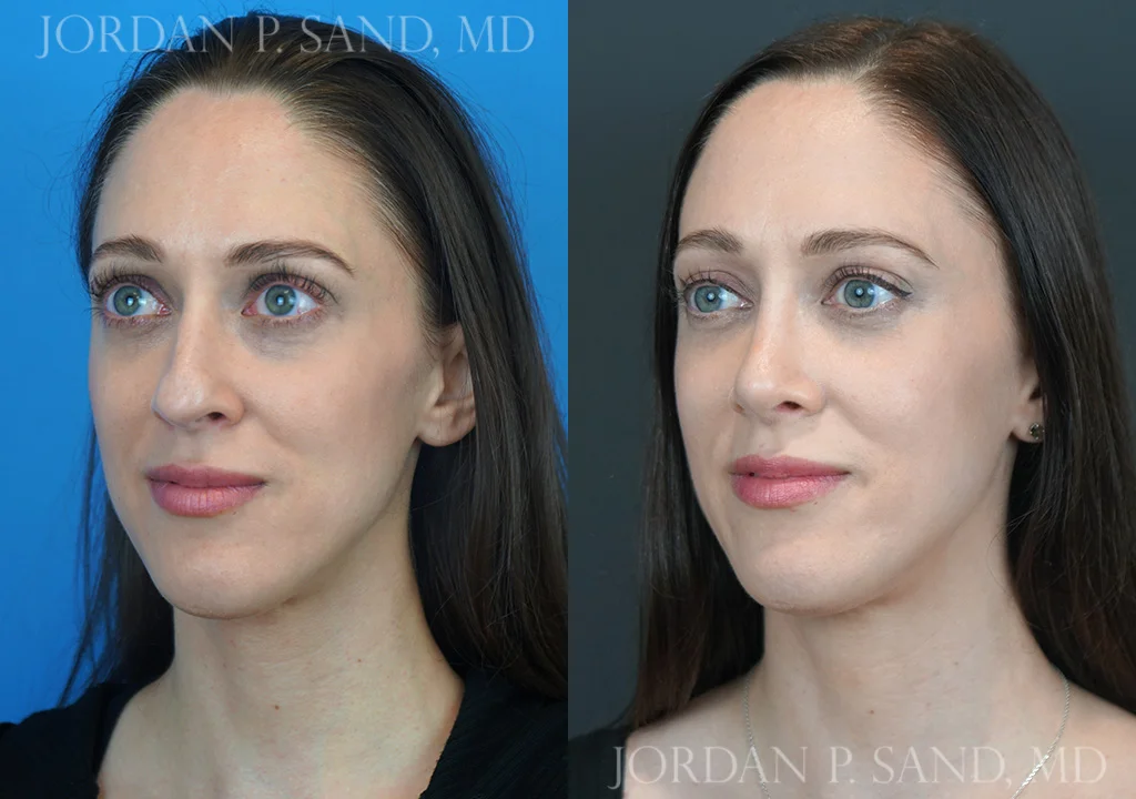 Before and after rhinoplasty — large, crooked nose balanced and refined