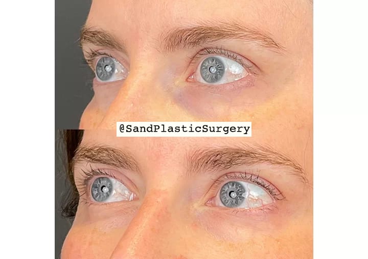 Before and after PRP under-eye treatment — collagen stimulated, dark circles reduced