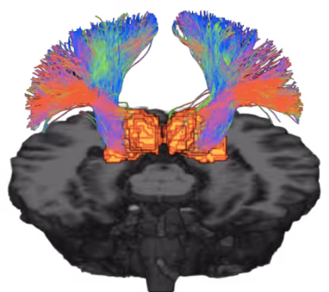 Colorful research brain scan in coronal view