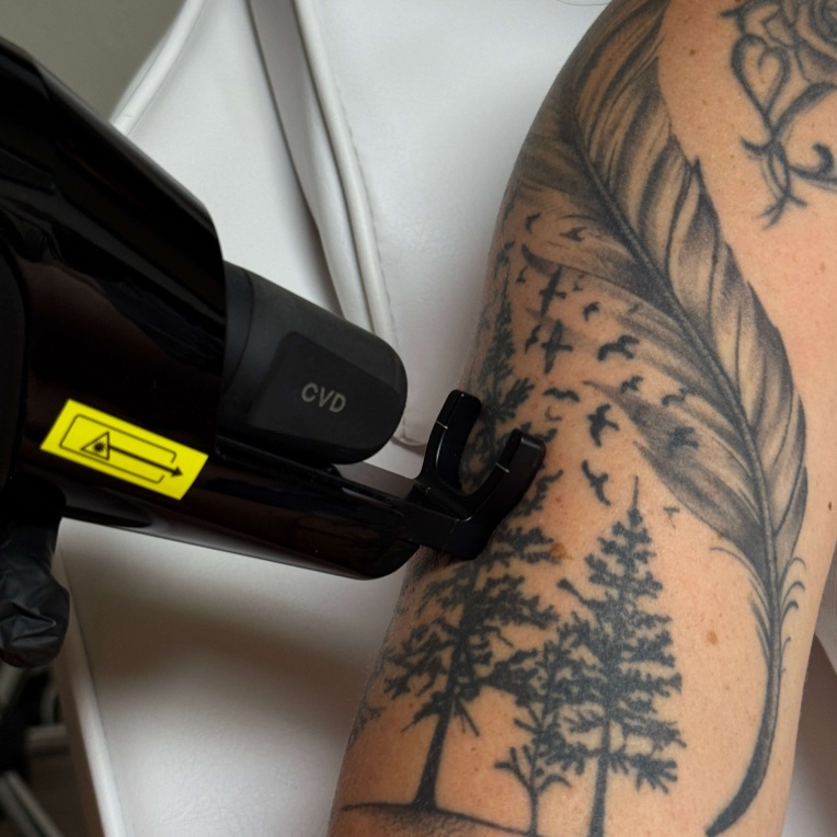 Tattoo Removal