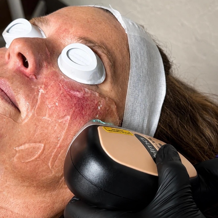 IPL (Intense Pulsed Light)