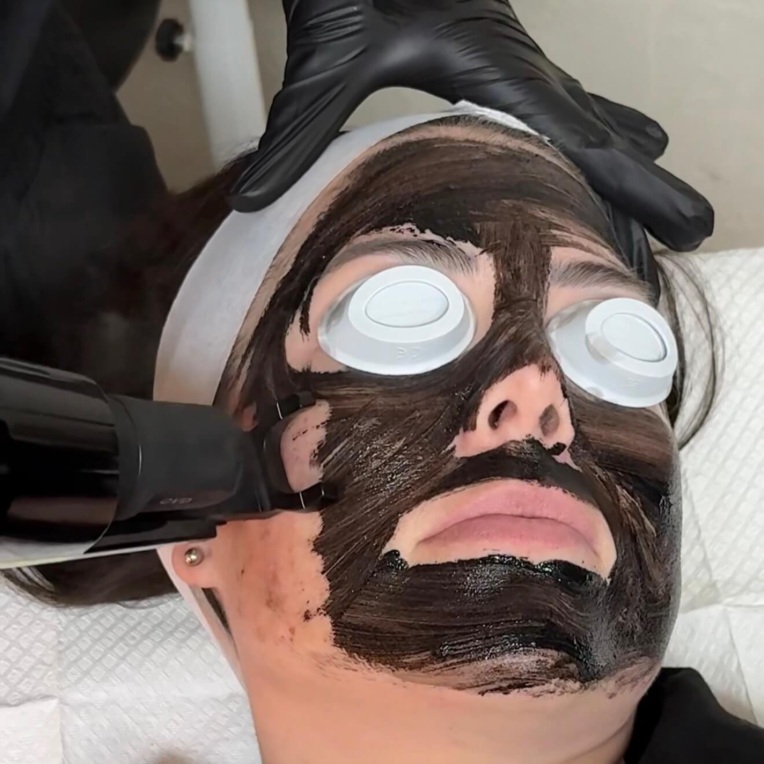 Carbon Laser Facial