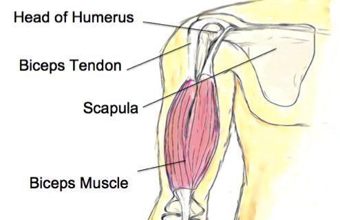 biceps tendonitis
