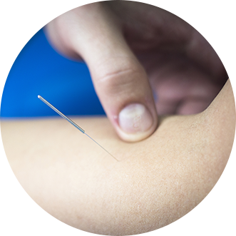 Melbourne Physio Dry Needling