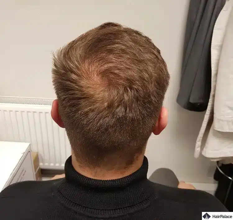 After crown placeholder