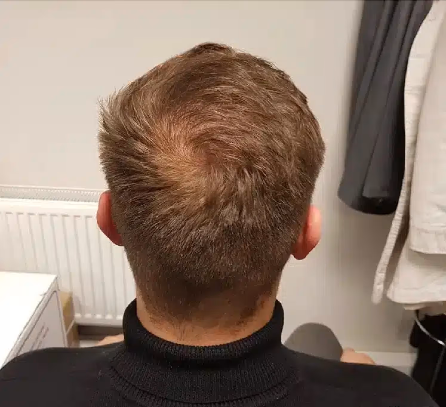 After crown placeholder