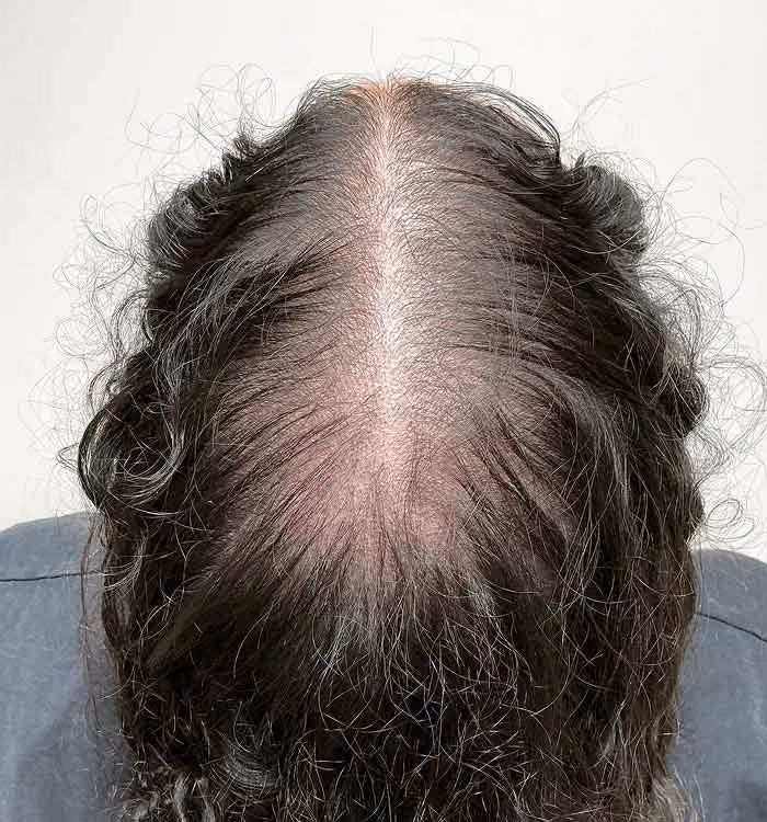 Diffuser Haarausfall bei einer Frau: weniger Haardichte über die ganze Kopfhaut