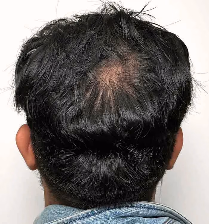Nachher: Mann, 40 Jahre, Hinterkopf nach der regenerativen Haartherapie