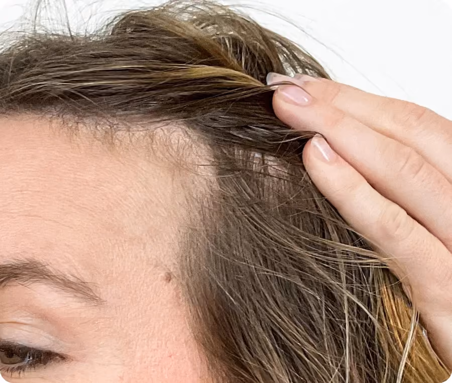 Vorher: Frau, 31 Jahre, Geheimratsecken vor der regenerativen Haartherapie