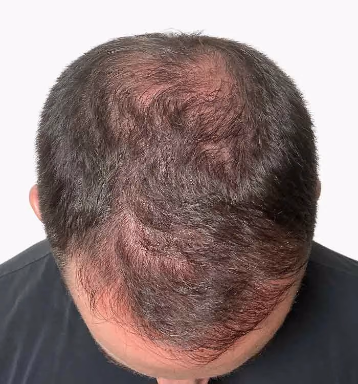 Nachher: Mann, 38 Jahre, Hinterkopf nach der regenerativen Haartherapie