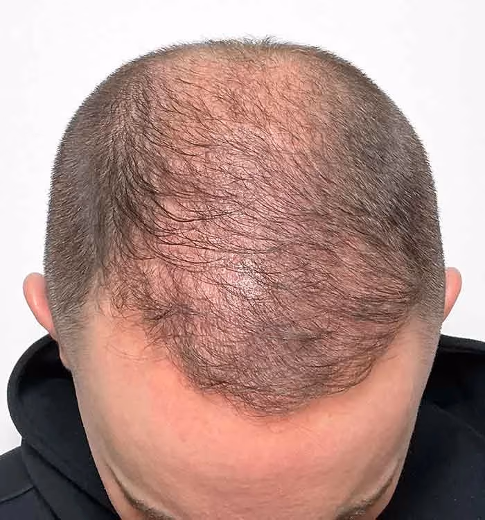 Vorher: Mann, 38 Jahre, Hinterkopf vor der regenerativen Haartherapie