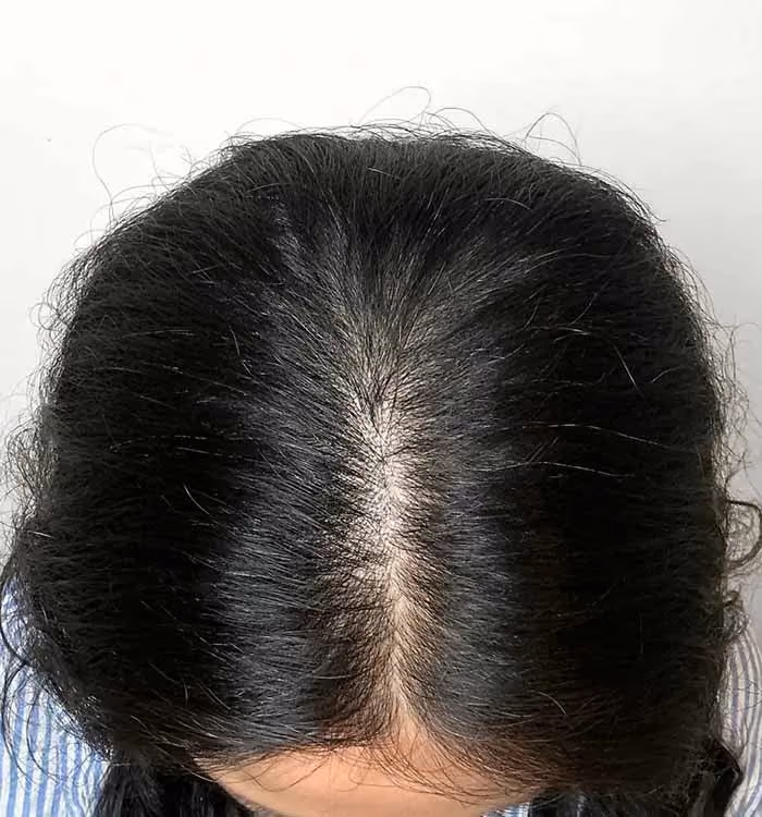 Nachher: Frau, 39 Jahre, Scheitel nach der regenerativen Haartherapie