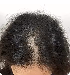 Vorher: Frau, 39 Jahre, Scheitel vor der regenerativen Haartherapie