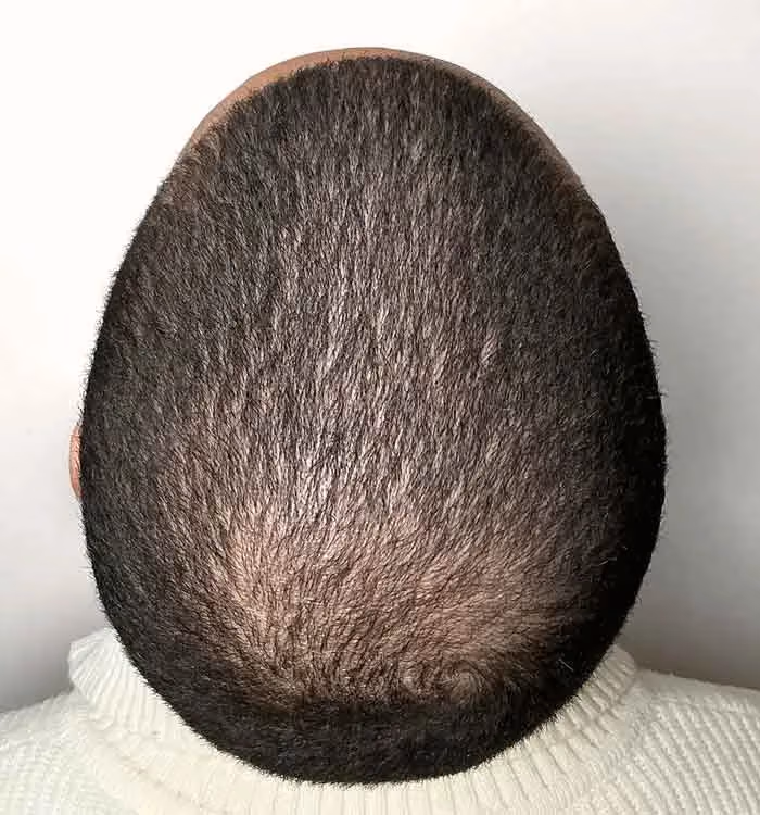 Vorher: Mann, 33 Jahre, Hinterkopf vor der regenerativen Haartherapie