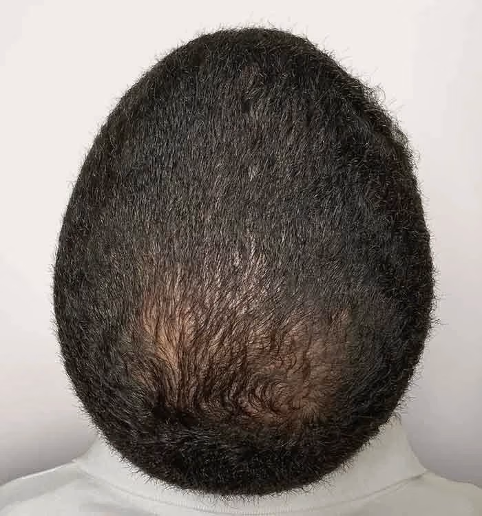 Nachher: Mann, 33 Jahre, Hinterkopf nach der regenerativen Haartherapie