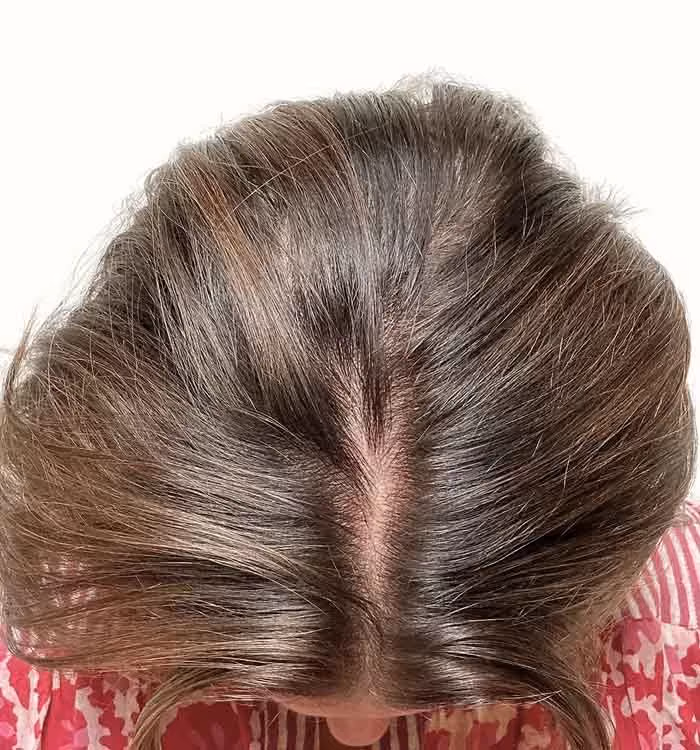 Nachher: Frau, 49 Jahre, Scheitel nach der regenerativen Haartherapie