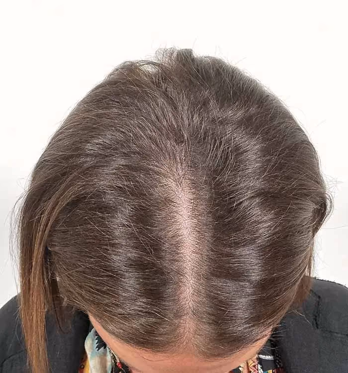 Vorher: Frau, 49 Jahre, Scheitel vor der regenerativen Haartherapie