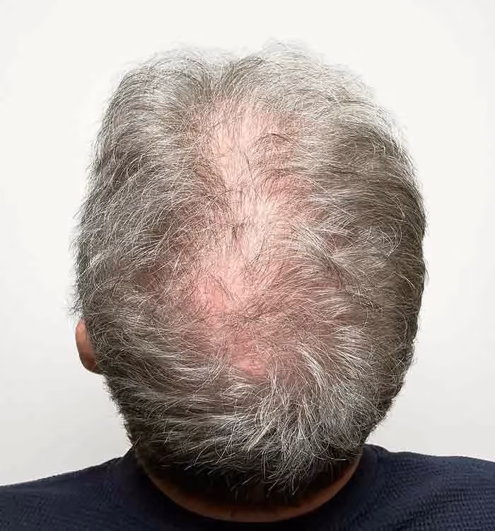Vorher: Mann, 58 Jahre, Hinterkopf vor der regenerativen Haartherapie