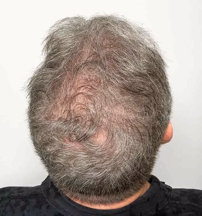 Nachher: Mann, 58 Jahre, Hinterkopf nach der regenerativen Haartherapie