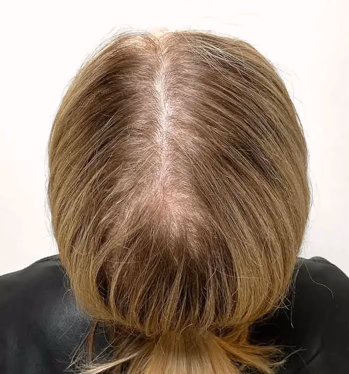 Vorher: Frau, 29 Jahre, Scheitel vor der regenerativen Haartherapie