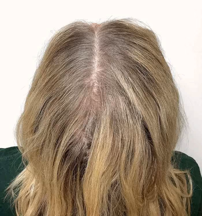 Nachher: Frau, 29 Jahre, Scheitel nach der regenerativen Haartherapie